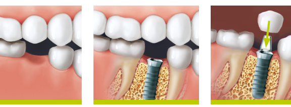 Implant dentar Bucuresti
